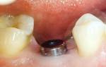 Имплантация зубов формирователь десны