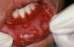 Воспаление слизистой во рту лечение