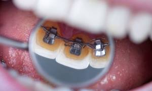 Брекеты с внутренней стороны зубов