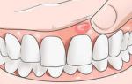 Болит надкостница зуба что делать