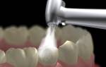 Виды пломб в стоматологии