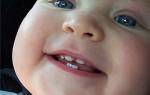 Высокая температура у ребенка на зубы