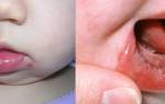 Чем лечить герпес во рту у ребенка