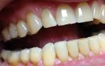 Пломба на передних зубах