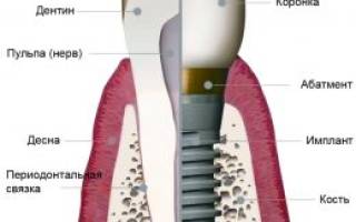 Имплантанты зубов что это такое
