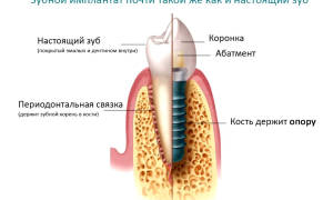 Импланты зубов как делают