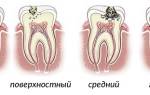 Болит зуб после пломбирования что делать