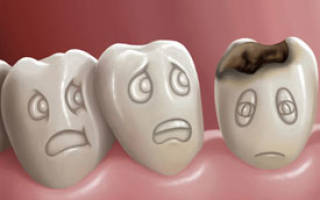 Кариес зубов симптомы