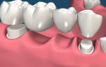 Что такое мост в стоматологии